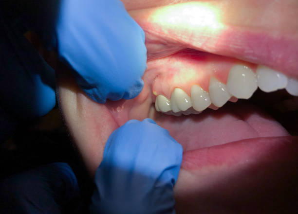 Best Tooth Infection Emergency Dentist  in Pine Beach, NJ